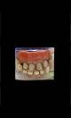Dentier vampire 4